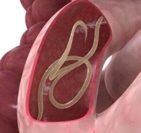 Spulwürmer kommen im menschlichen Darm recht häufig vor. 