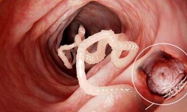 wie man das Vorhandensein von Parasiten im menschlichen Darm erkennt